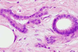 Tumour acinus on left and normal duct on right - note similarity of nuclear size
